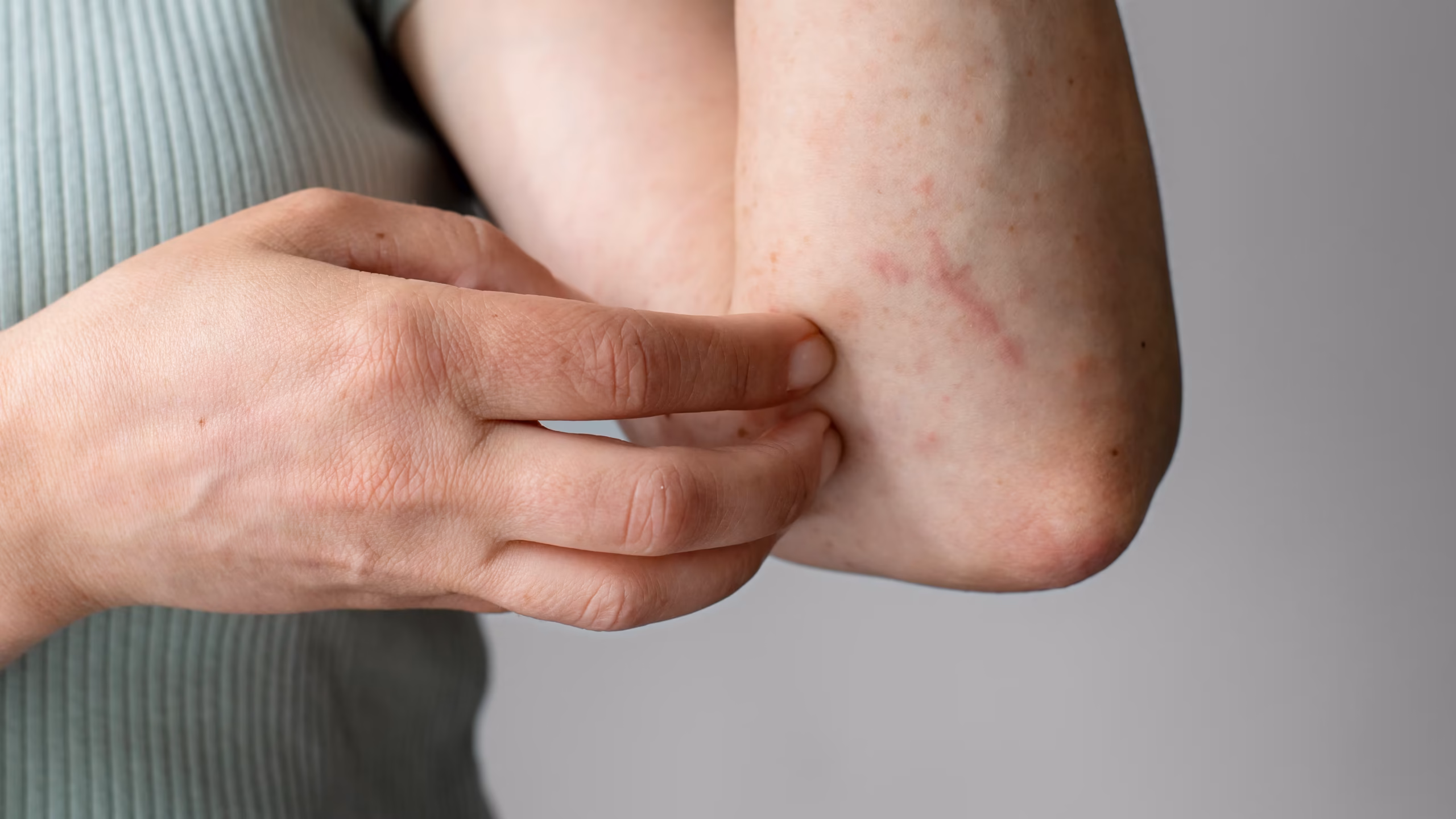 Urticaria emocional e urticaria crônica em Curitiba