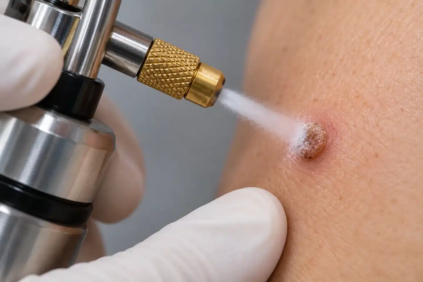 Aplicador de crioterapia com nitrogênio líquido direcionado a uma verruga na pele.
