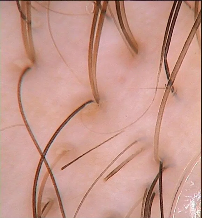 Imagem de tricoscopia ilustrativa em close-up, com fios emergindo de uma área do couro cabeludo.