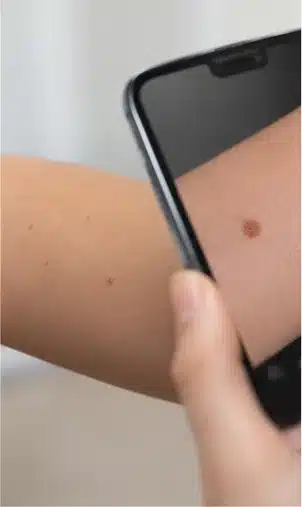 Celular diante de uma área da pele para ilustrar um registro remoto; cena sintética, sem paciente real.