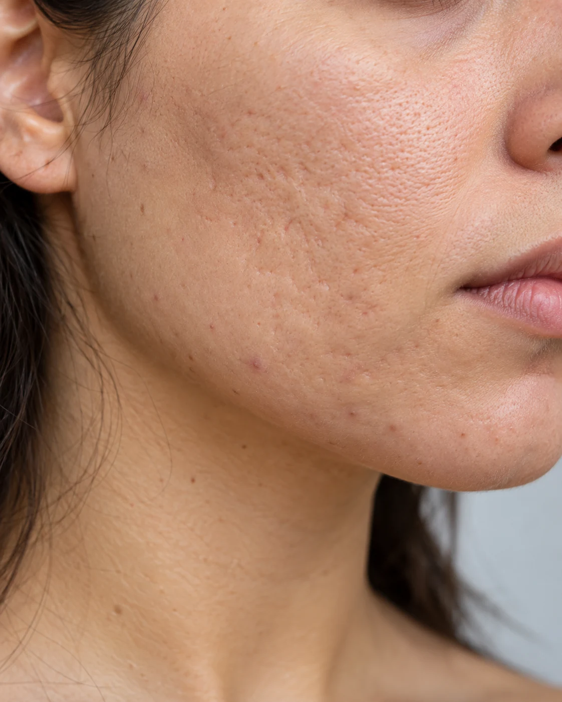 Ilustração gerada por IA de uma textura de pele com marcas que lembram cicatrizes de acne; não representa paciente real nem achado diagnóstico.