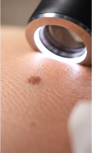 Dermatoscópio examina uma pinta em close; ilustração sintética, não é caso clínico nem referência diagnóstica.