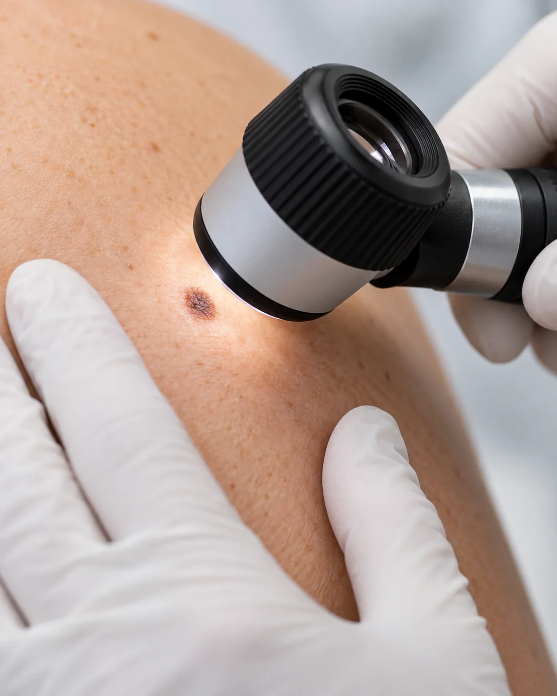Avaliação de uma pinta com dermatoscópio em pele. Ilustração gerada por IA; não representa paciente nem procedimento realizado pelo Dr. Augusto Galvão.