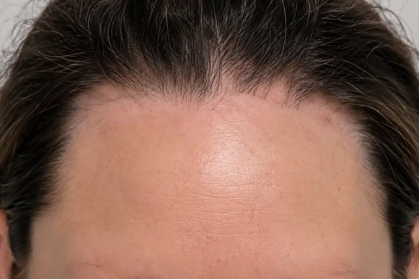 Recuo da linha de implantação dos cabelos na testa, sugestivo de alopecia frontal fibrosante.
