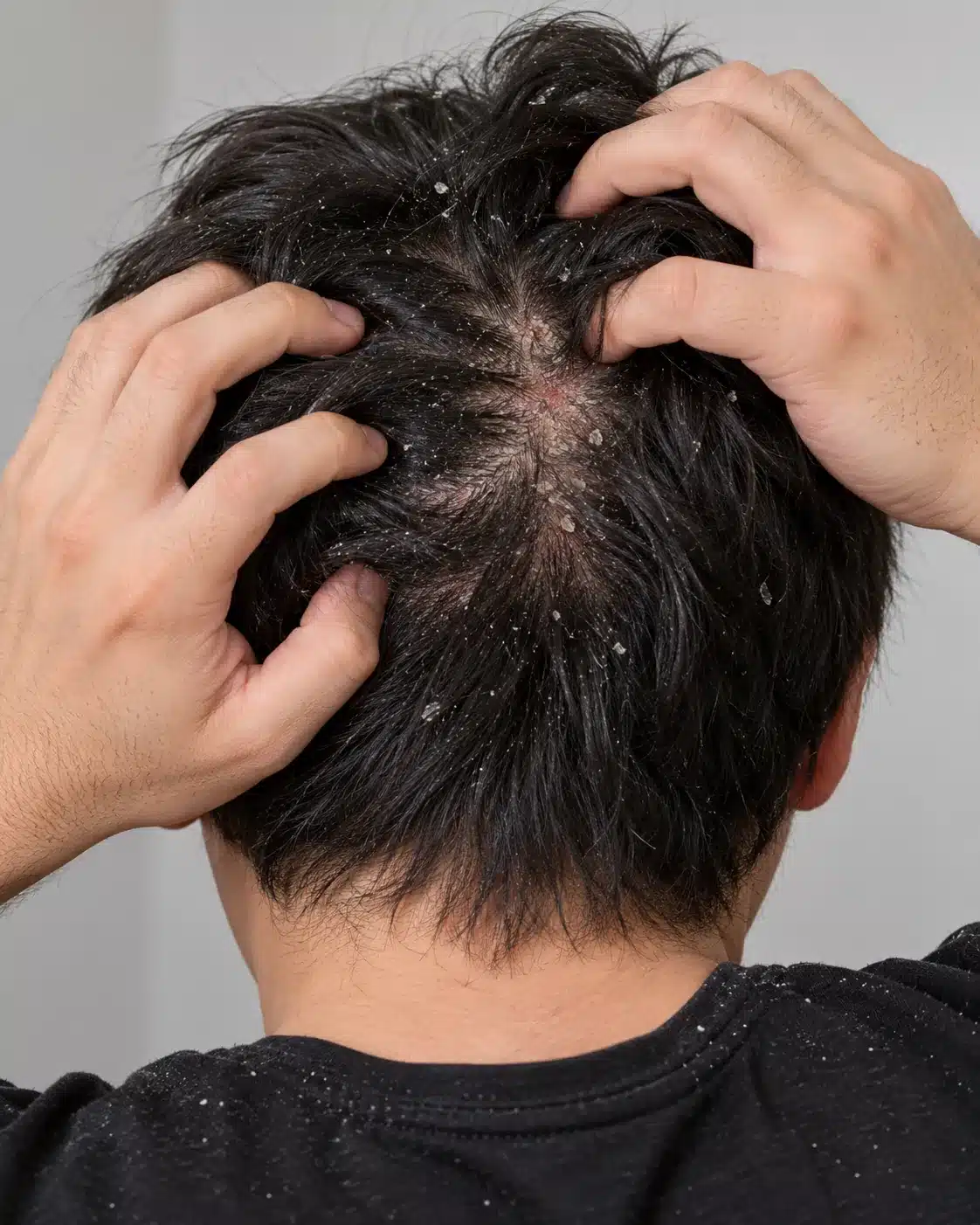 Pessoa coçando o couro cabeludo com descamação e caspa, sugestivas de dermatite seborreica.
