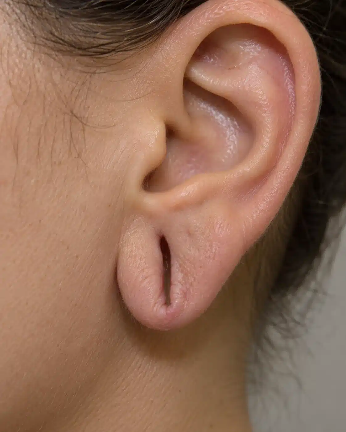 Lóbulo de orelha com furo alargado e fissura parcial, antes de lobuloplastia.